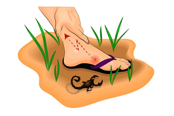 Scorpion Sting Treatment